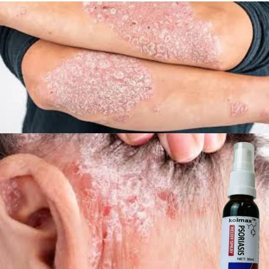 PAGA 1 LLEVA 2 KOLMAX®: Dile adiós a la Psoriasis (APROVECHA HOY)