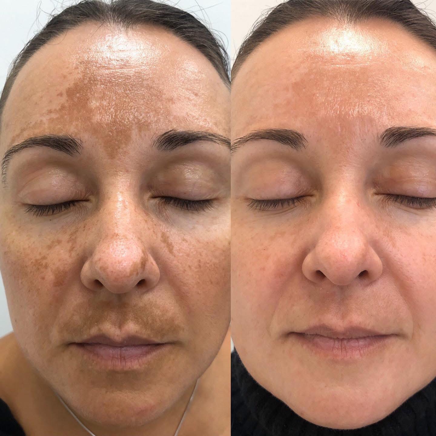 PAGA 1 LLEVA 2 Jorondy: Exfoliante y Aclarador de Manchas